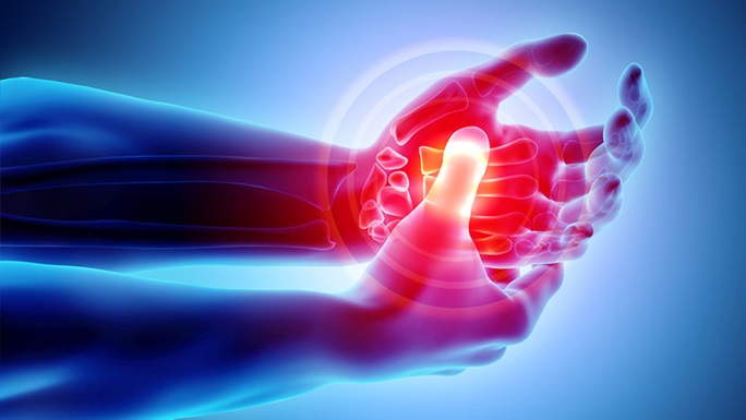 Top Things To Consider About Psoriatic Arthritis